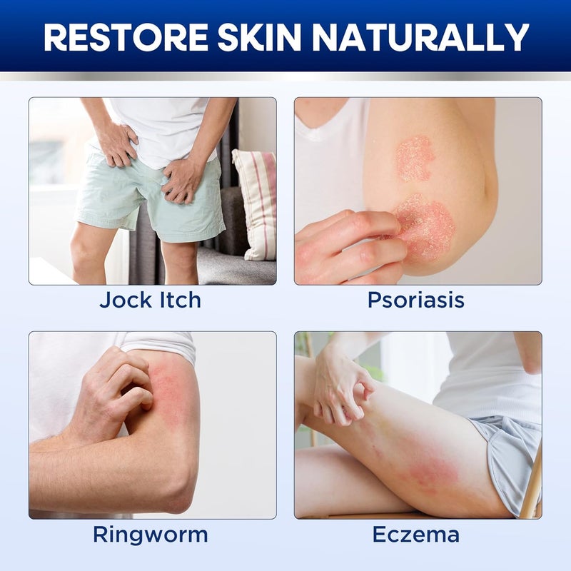 Hermon Clotrimazole Antifungal Treatment Cream & Soap Kit: Antifungal Cream for Athletes Foot, Jock Itch, Ringworm with Anti Fungal Soap - Relieves Itching Burning Cracking - 57g Tube / 113g Bar - Image 3